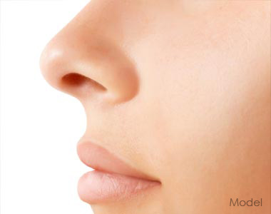 Revision Rhinoplasty Naples Florida Revision Rhinoplasty Naples Florida
