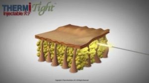 The Aesthetic Surgery Center is the first and only practice in Naples/Ft. Myers/Marco Island to offer ThermiTightTM to its patients.