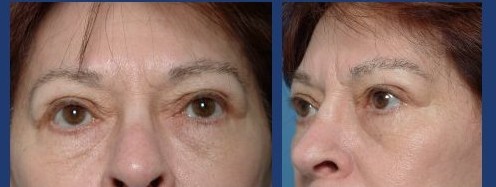 Before After | Eyebrow FL
