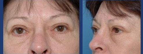 Before After | Eyebrow Naples
