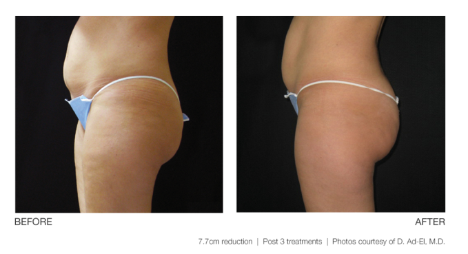 ultrashape-before-after