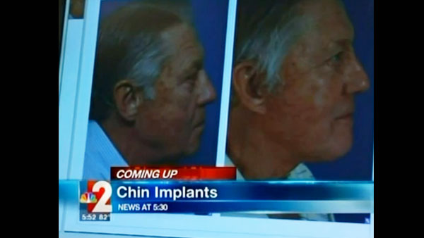 Chin Implant