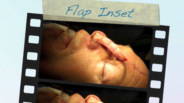 Dr. Agarwal performs nasal alar scar revision