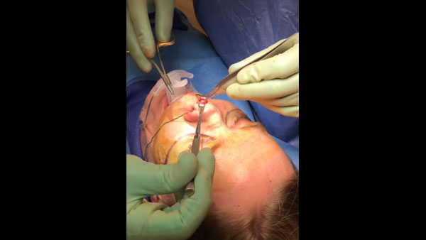 Refining the nasal tip during Rhinoplasty