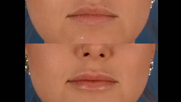 Naples Juvederm Injection to the Lips