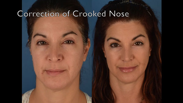 Revision rhinoplasty for a crooked nose