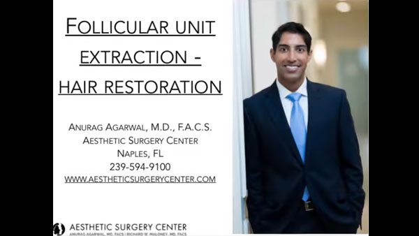 FUE hair restoration by Dr. Anurag Agarwal