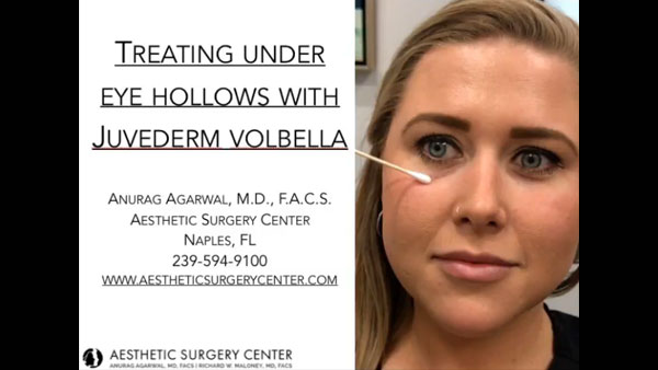 Treating Under Eye Hollows with Juvederm Volbella