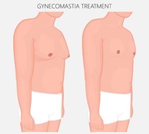 Can You Resolve Gynecomastia Without Surgery