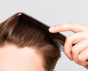 Hair Replacement photos - Aesthetic Surgery Center | Naples, FL Hair Replacement photos - Aesthetic Surgery Center | Naples, FL