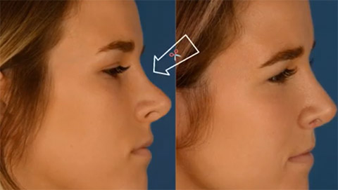 Revision Rhinoplasty by Dr. Anurag Agarwal using a dorsal onlay graft