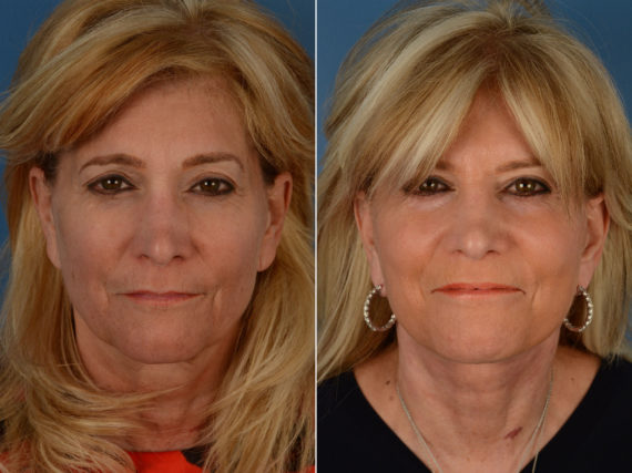 The UpLift™ Lower Face and Neck Lift Before and After Photos in Naples, FL, Patient 11873