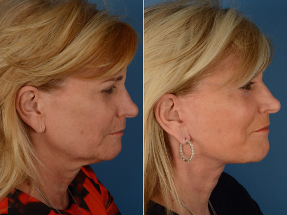 The UpLift™ Lower Face and Neck Lift Before and After Photos in Naples, FL, Patient 11873