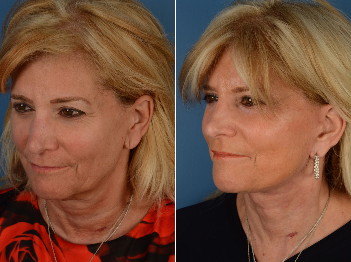 The UpLift™ Lower Face and Neck Lift Before and After Photos in Naples, FL, Patient 11873