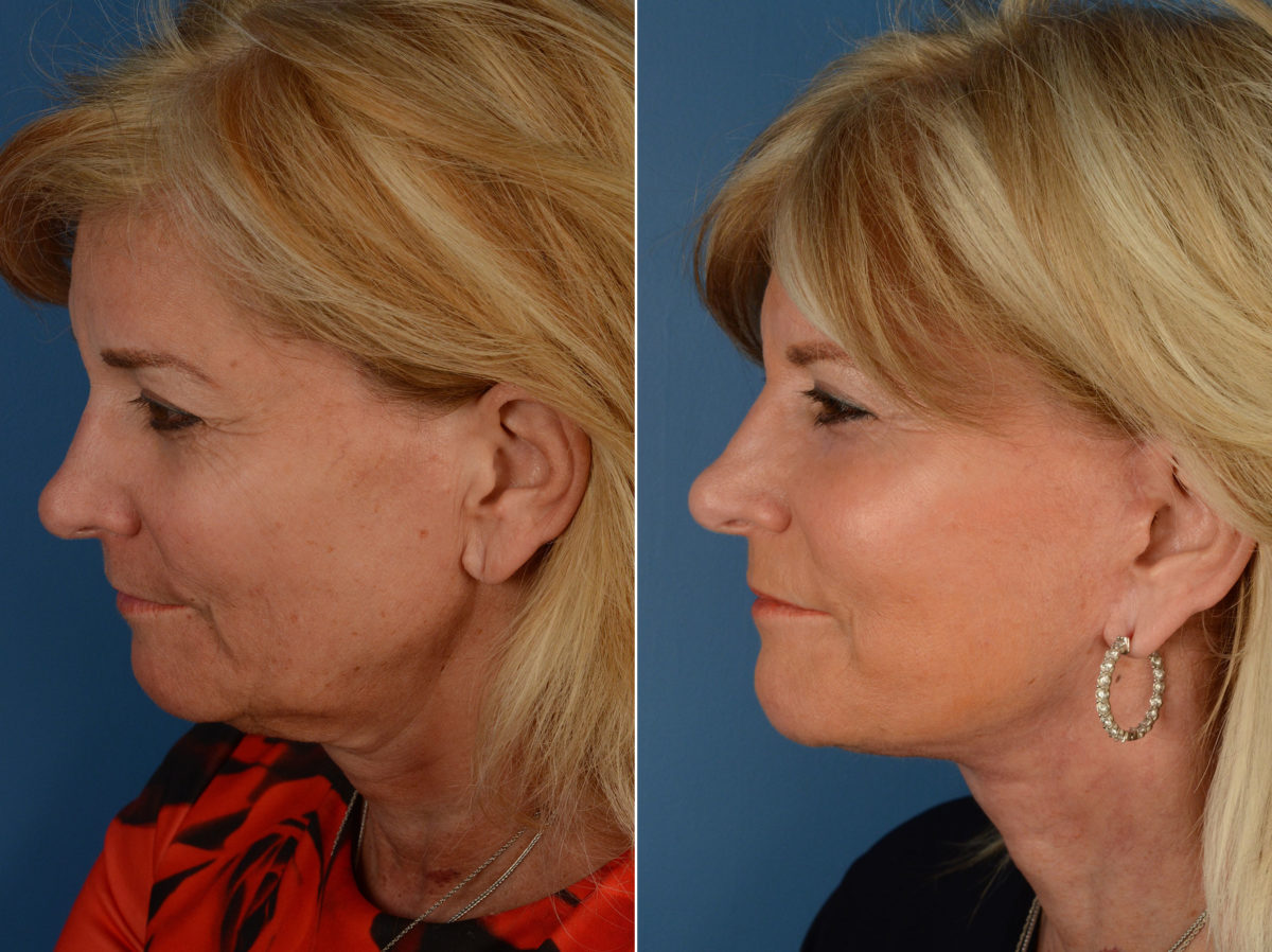 The UpLift™ Lower Face and Neck Lift Before and After Photos in Naples, FL, Patient 11873