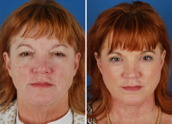 The UpLift™ Lower Face and Neck Lift Before and After Photos in Naples, FL, Patient 8766