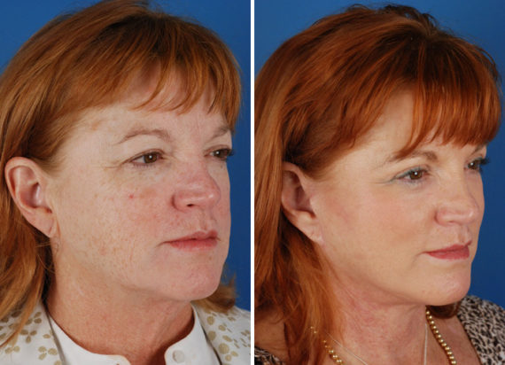 The UpLift™ Lower Face and Neck Lift Before and After Photos in Naples, FL, Patient 8766