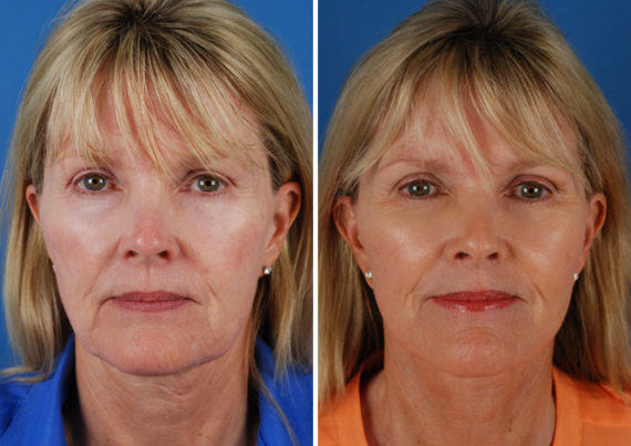 The UpLift™ Lower Face and Neck Lift Before and After Photos in Naples, FL, Patient 8773