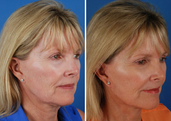 The UpLift™ Lower Face and Neck Lift Before and After Photos in Naples, FL, Patient 8773