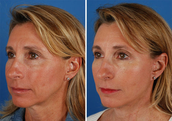 The UpLift™ Lower Face and Neck Lift Before and After Photos in Naples, FL, Patient 8817