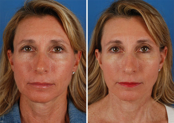 The UpLift™ Lower Face and Neck Lift Before and After Photos in Naples, FL, Patient 8817