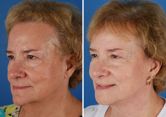 The UpLift™ Lower Face and Neck Lift Before and After Photos in Naples, FL, Patient 8803