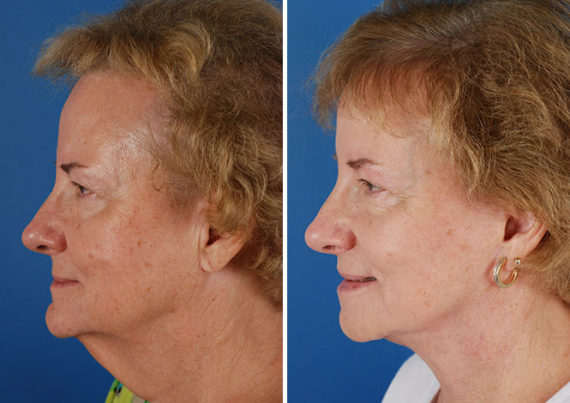 The UpLift™ Lower Face and Neck Lift Before and After Photos in Naples, FL, Patient 8803