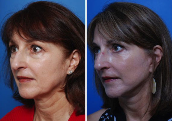 The UpLift™ Lower Face and Neck Lift Before and After Photos in Naples, FL, Patient 8787