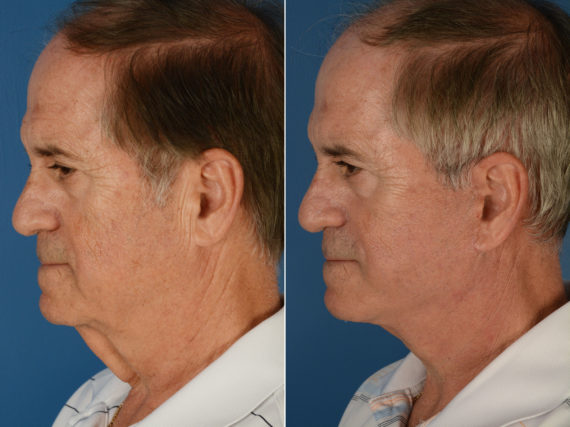 The UpLift™ Lower Face and Neck Lift Before and After Photos in Naples, FL, Patient 11994