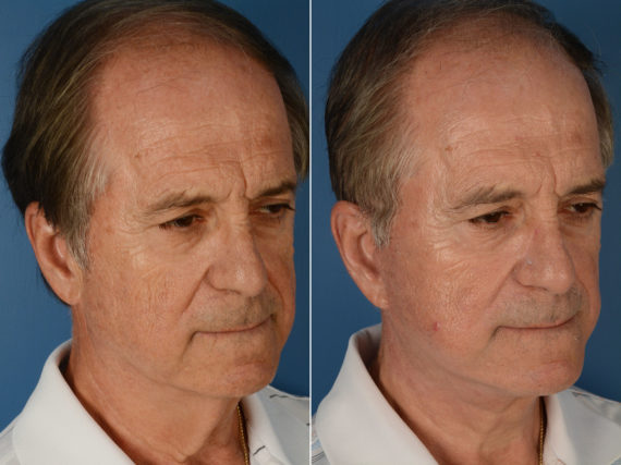 The UpLift™ Lower Face and Neck Lift Before and After Photos in Naples, FL, Patient 11994