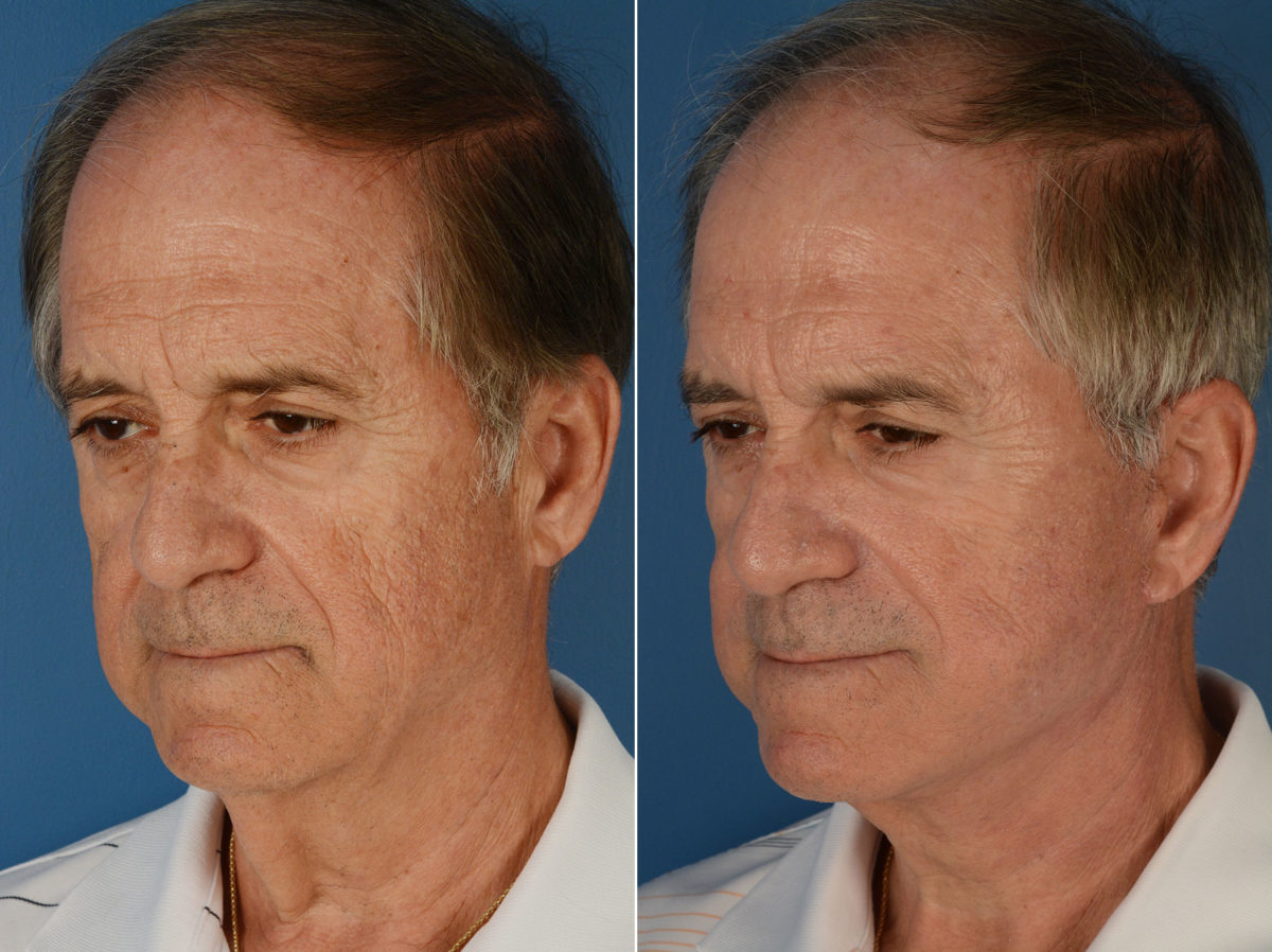 The UpLift™ Lower Face and Neck Lift Before and After Photos in Naples, FL, Patient 11994