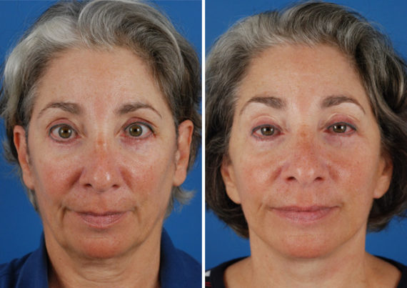 The UpLift™ Lower Face and Neck Lift Before and After Photos in Naples, FL, Patient 8794