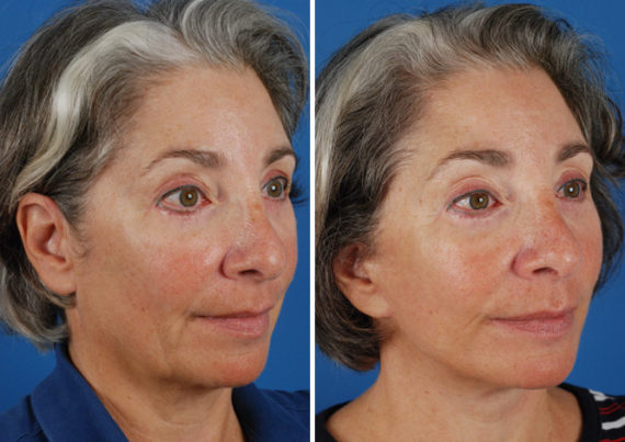 The UpLift™ Lower Face and Neck Lift Before and After Photos in Naples, FL, Patient 8794