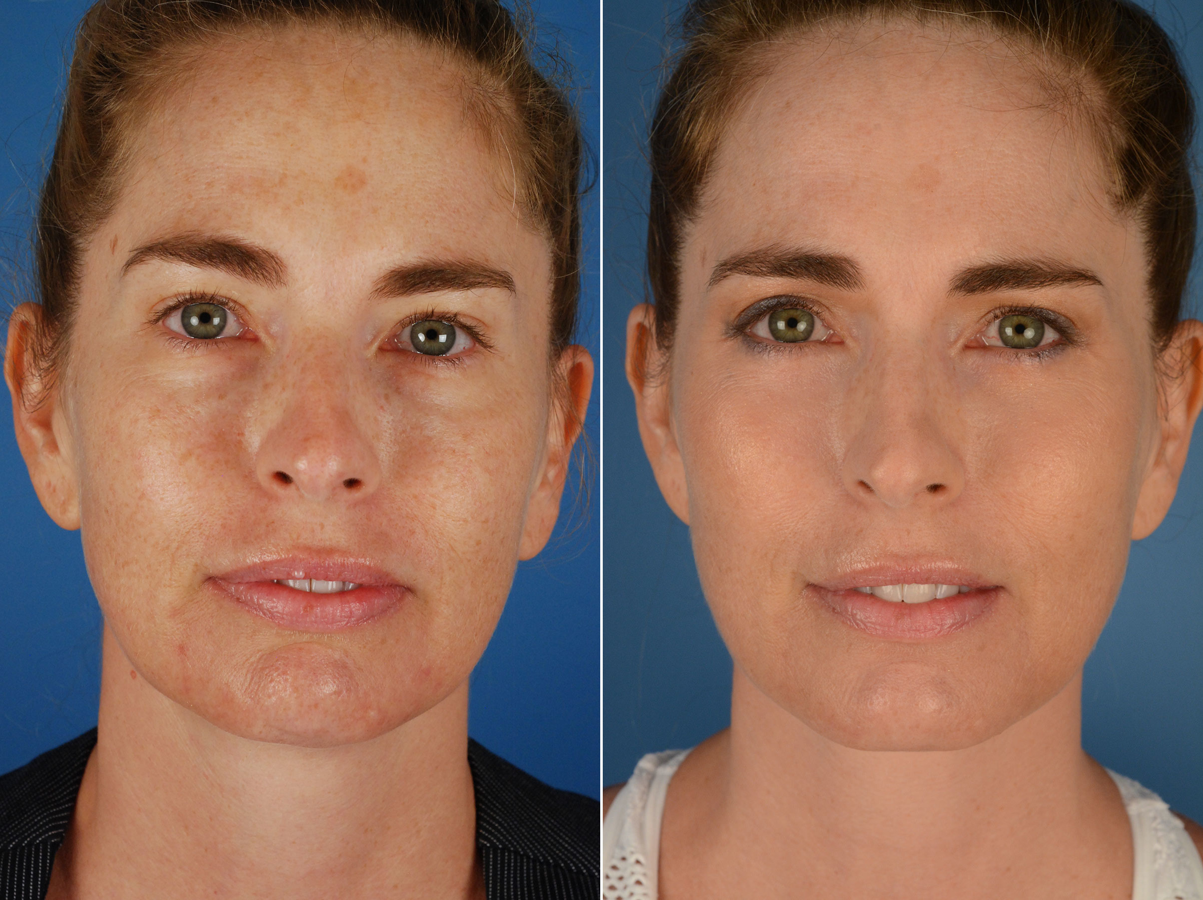 Blepharoplasty Photos Naples Fl Patient 11894