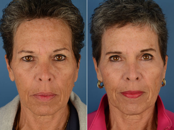 Blepharoplasty Before and After Photos in Naples, FL, Patient 12296