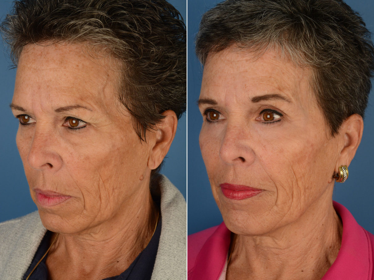 Blepharoplasty Before and After Photos in Naples, FL, Patient 12296