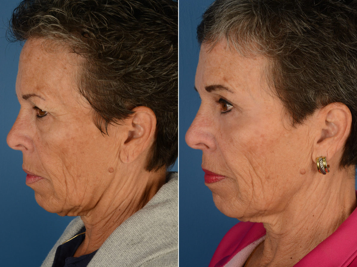 Blepharoplasty Before and After Photos in Naples, FL, Patient 12296