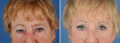 Blepharoplasty Before and After Photos in Naples, FL, Patient 11131