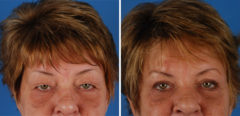 Blepharoplasty Before and After Photos in Naples, FL, Patient 8258