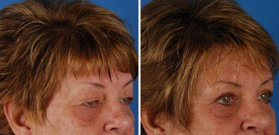 Blepharoplasty Before and After Photos in Naples, FL, Patient 8258