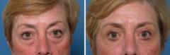 Blepharoplasty Before and After Photos in Naples, FL, Patient 8265