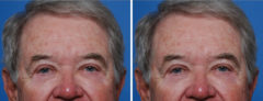 Blepharoplasty Before and After Photos in Naples, FL, Patient 8279