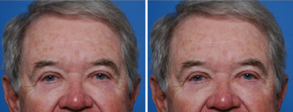 Blepharoplasty Before and After Photos in Naples, FL, Patient 8279