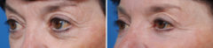 Blepharoplasty Before and After Photos in Naples, FL, Patient 8273