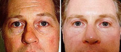 Blepharoplasty Before and After Photos in Naples, FL, Patient 8276