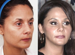 Blepharoplasty Before and After Photos in Naples, FL, Patient 8287