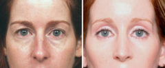 Blepharoplasty Before and After Photos in Naples, FL, Patient 8250