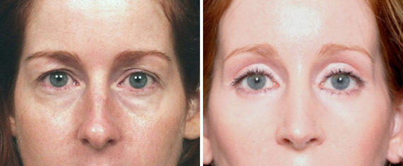 Blepharoplasty Before and After Photos in Naples, FL, Patient 8250