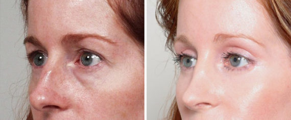 Blepharoplasty Before and After Photos in Naples, FL, Patient 8250