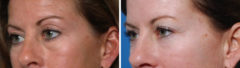 Blepharoplasty Before and After Photos in Naples, FL, Patient 8270